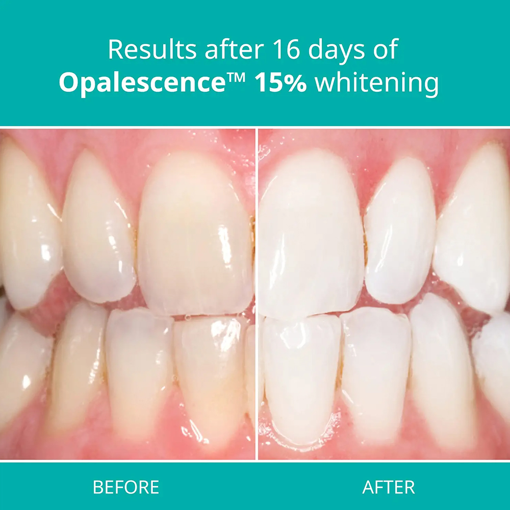 Teeth Whitening Gel Home Kit D - Teeth Whitening Gel Opalescence ulasan dan harga