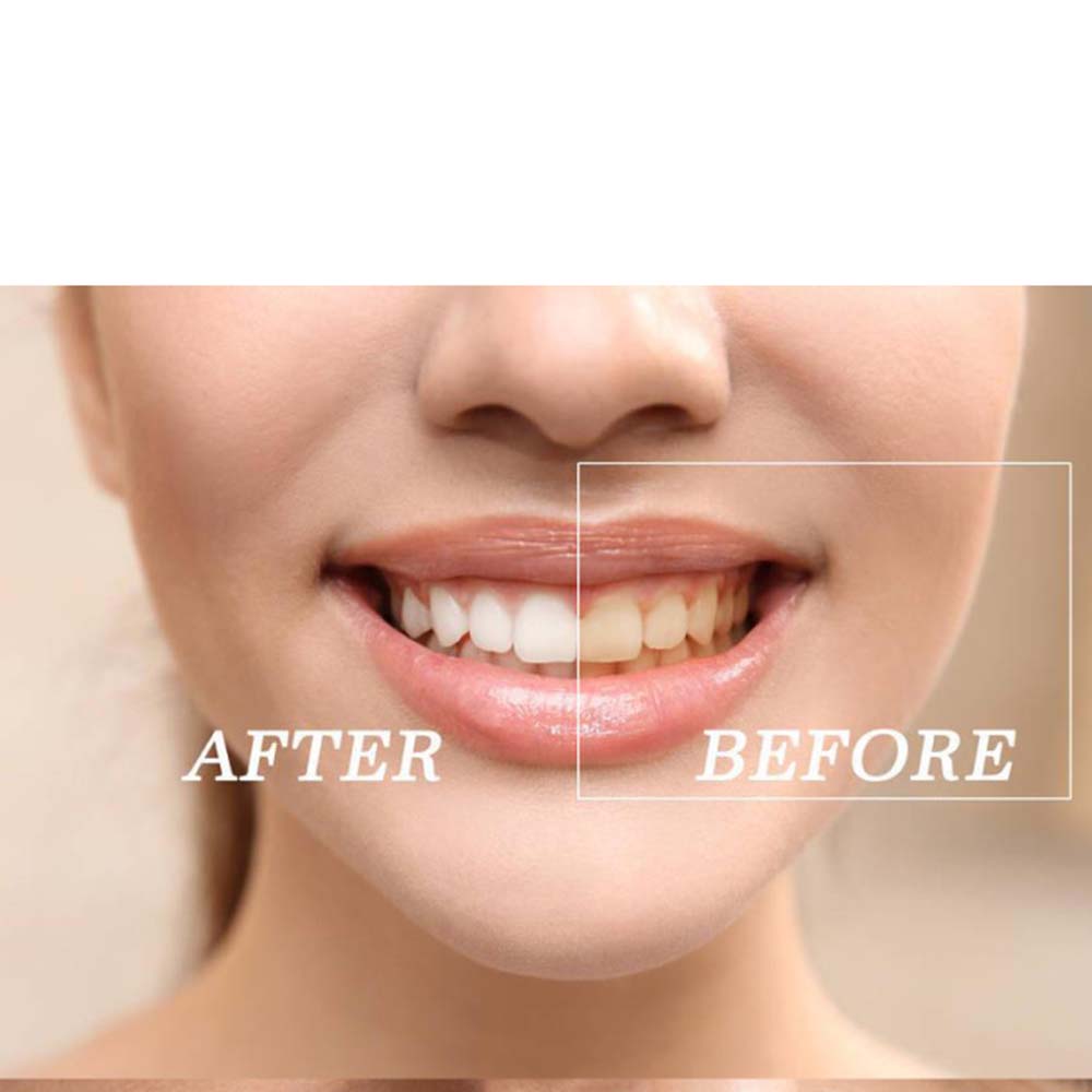 Top Quality Peroxide Teeth Whi - Teeth Whitening With Peroxide ulasan dan harga
