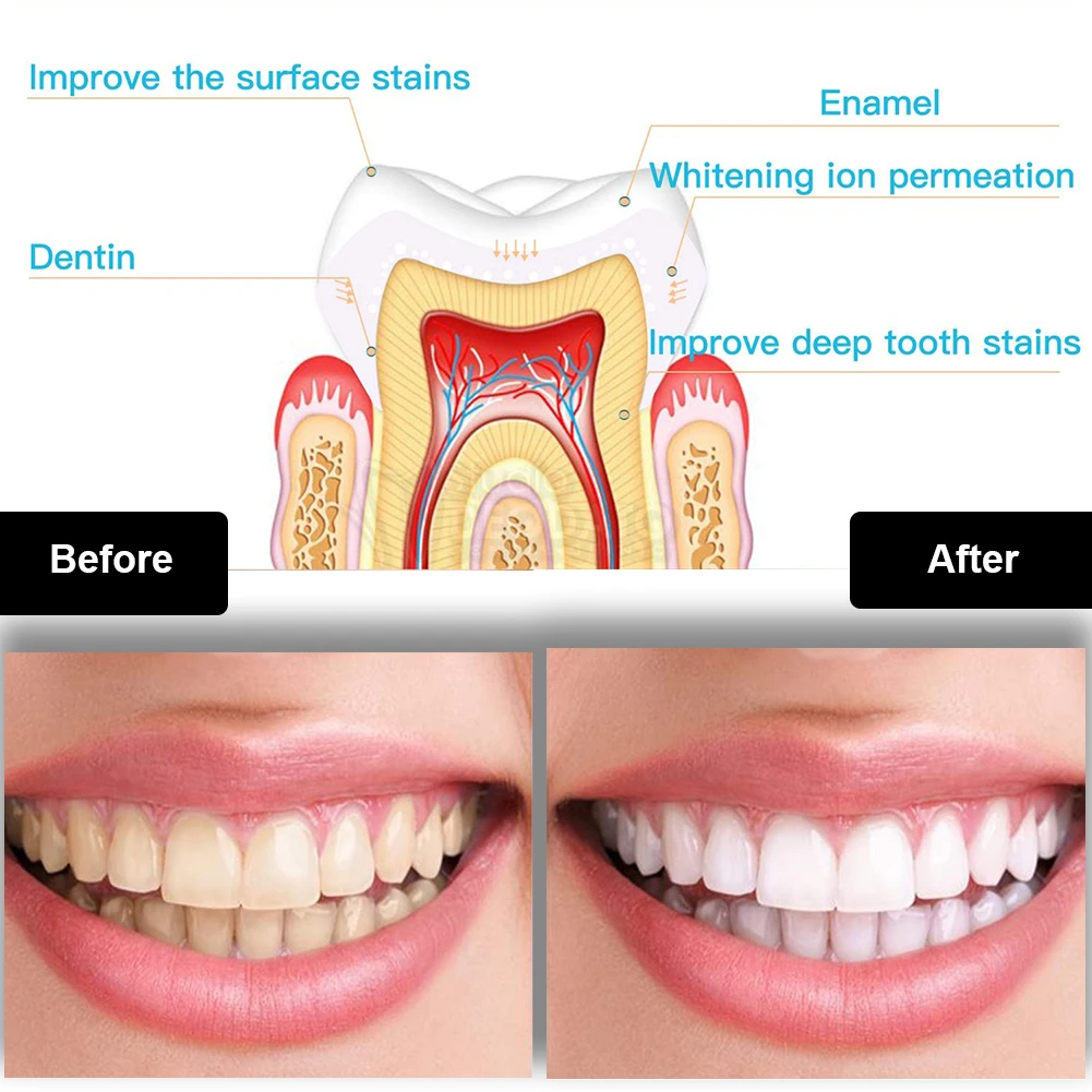 Dental Teeth Whitening Kit Min - Teeth Whitening With Peroxide ulasan dan harga